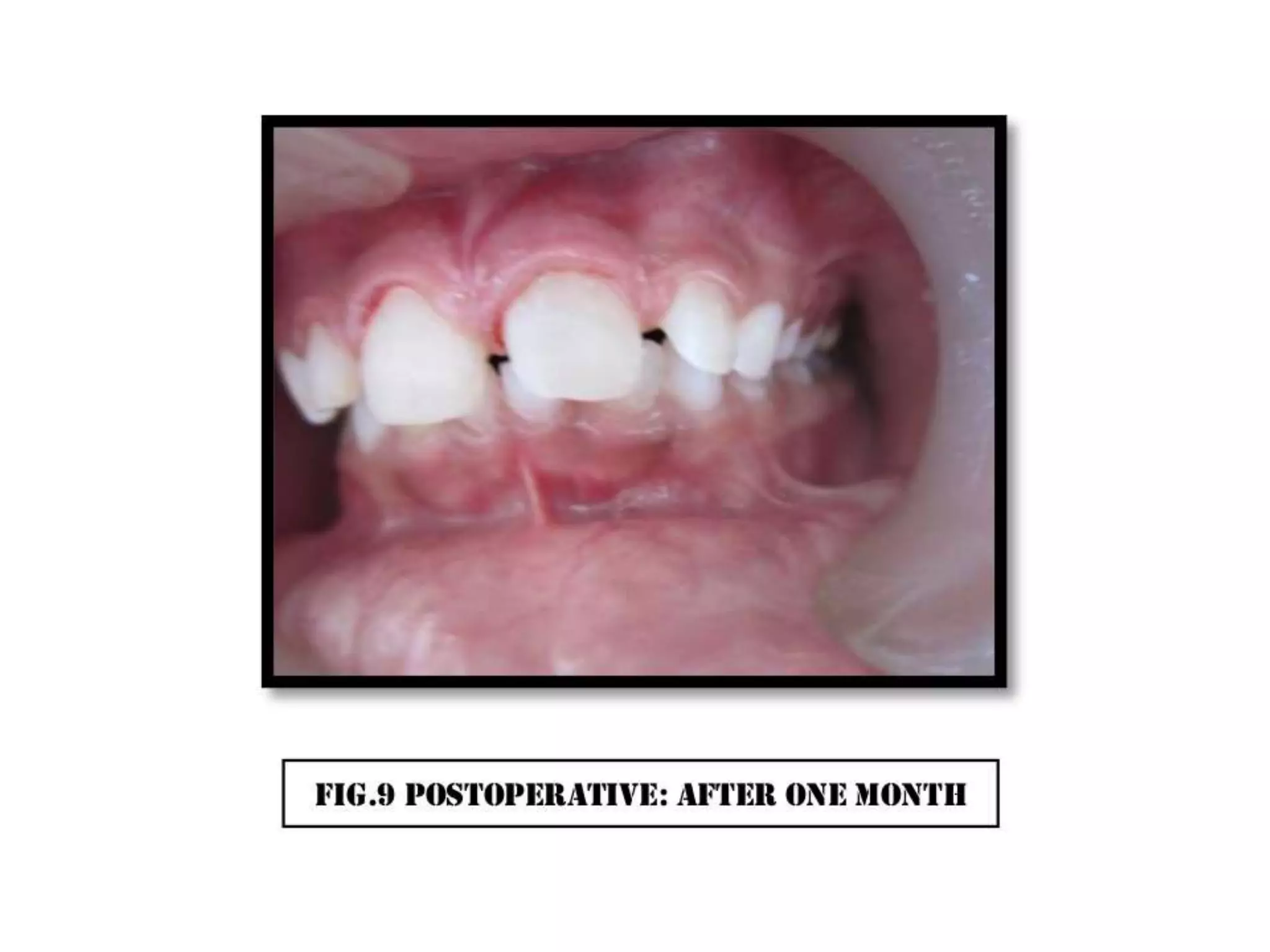 A case of cvek pulpotomy with mta