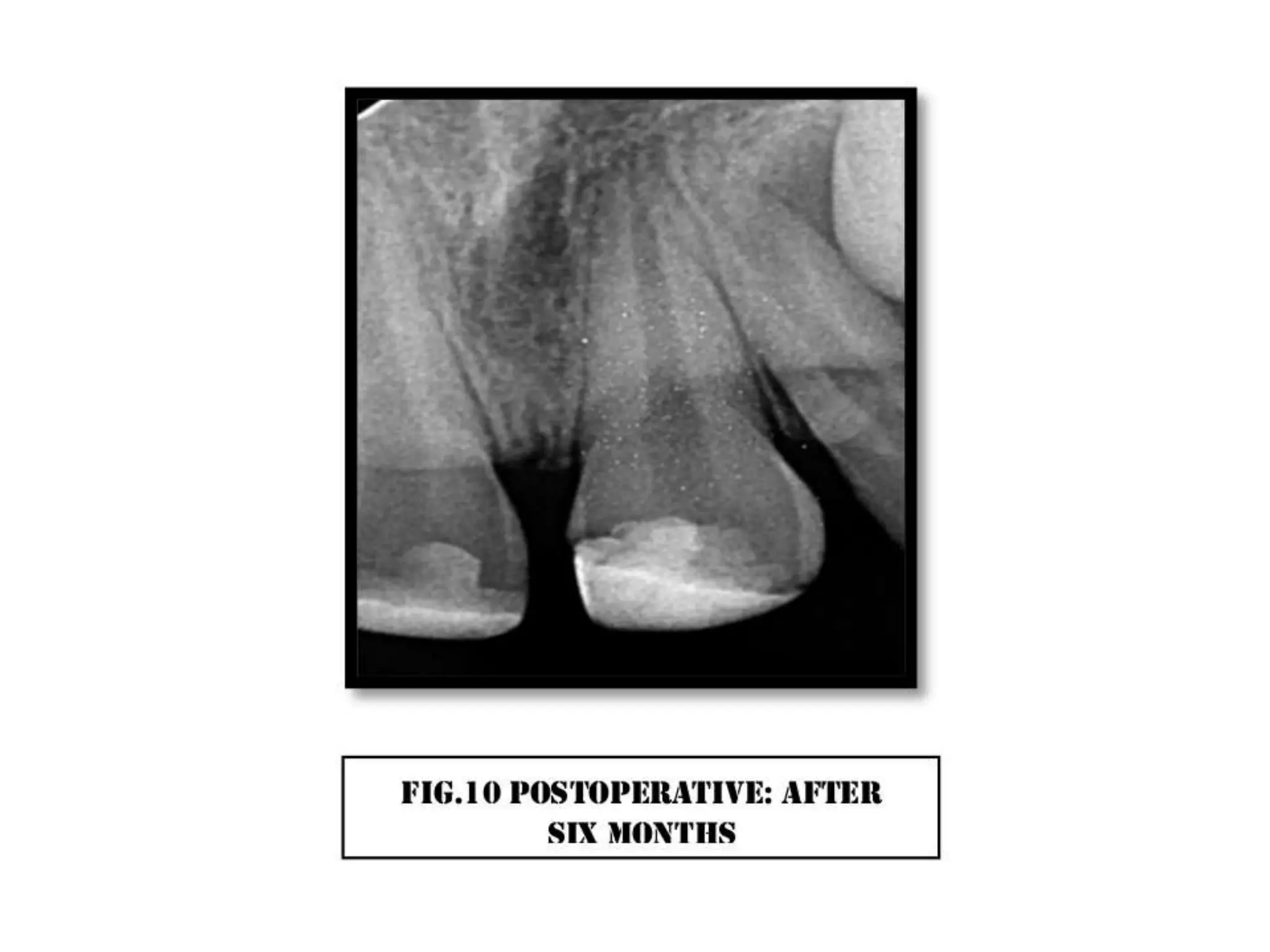 A case of cvek pulpotomy with mta