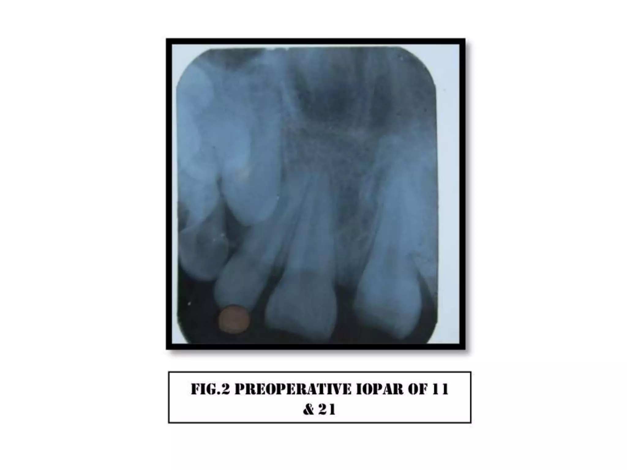A case of cvek pulpotomy with mta