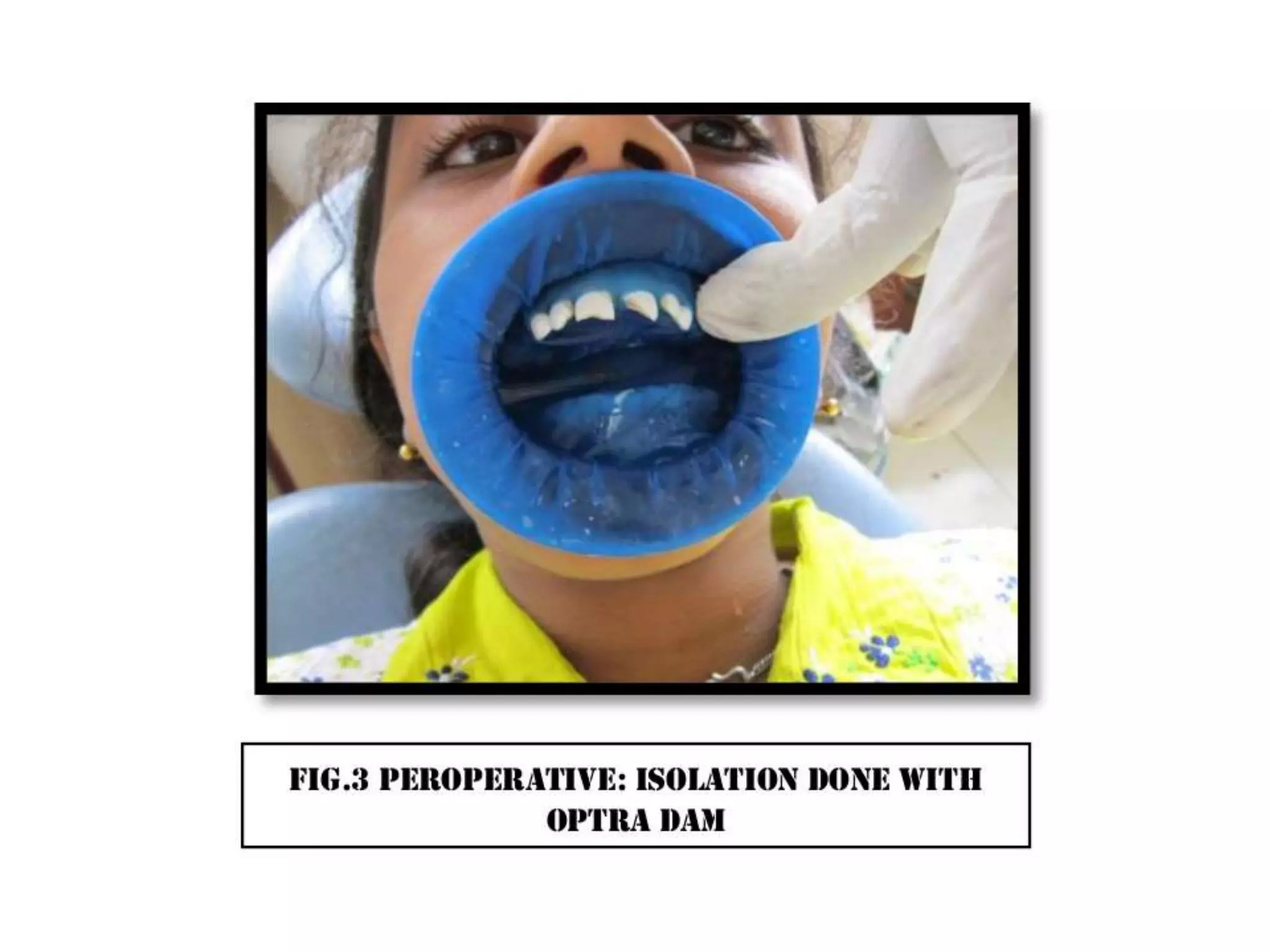 A case of cvek pulpotomy with mta