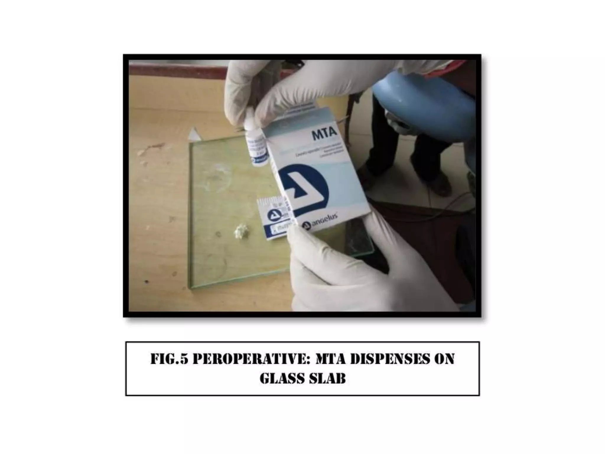 A case of cvek pulpotomy with mta