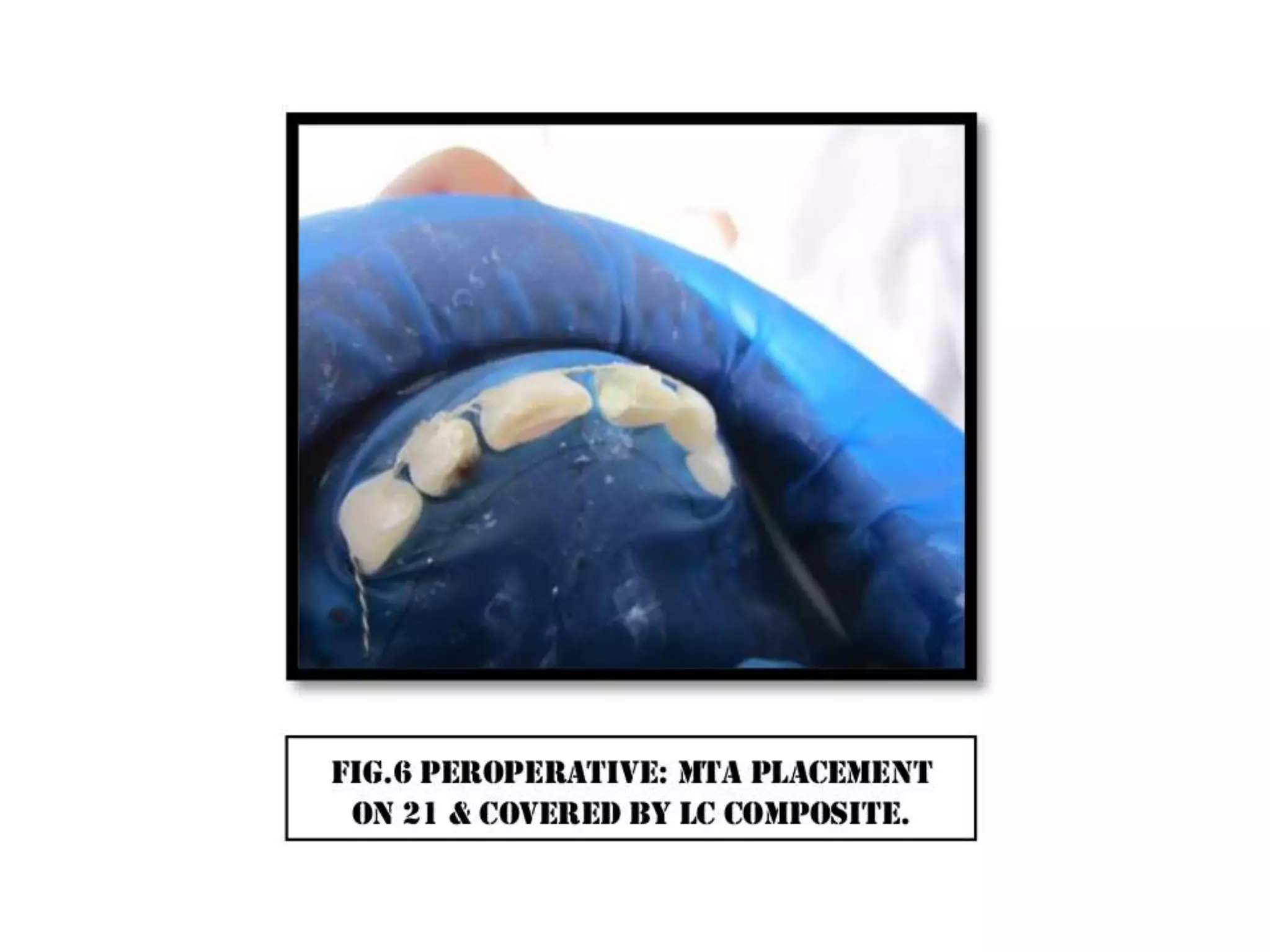 A case of cvek pulpotomy with mta