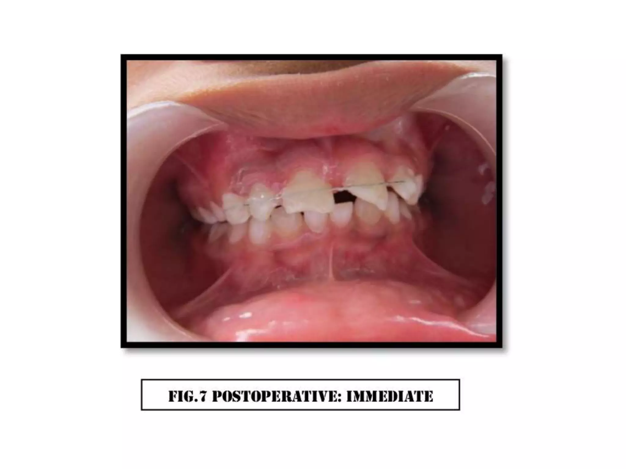 A case of cvek pulpotomy with mta