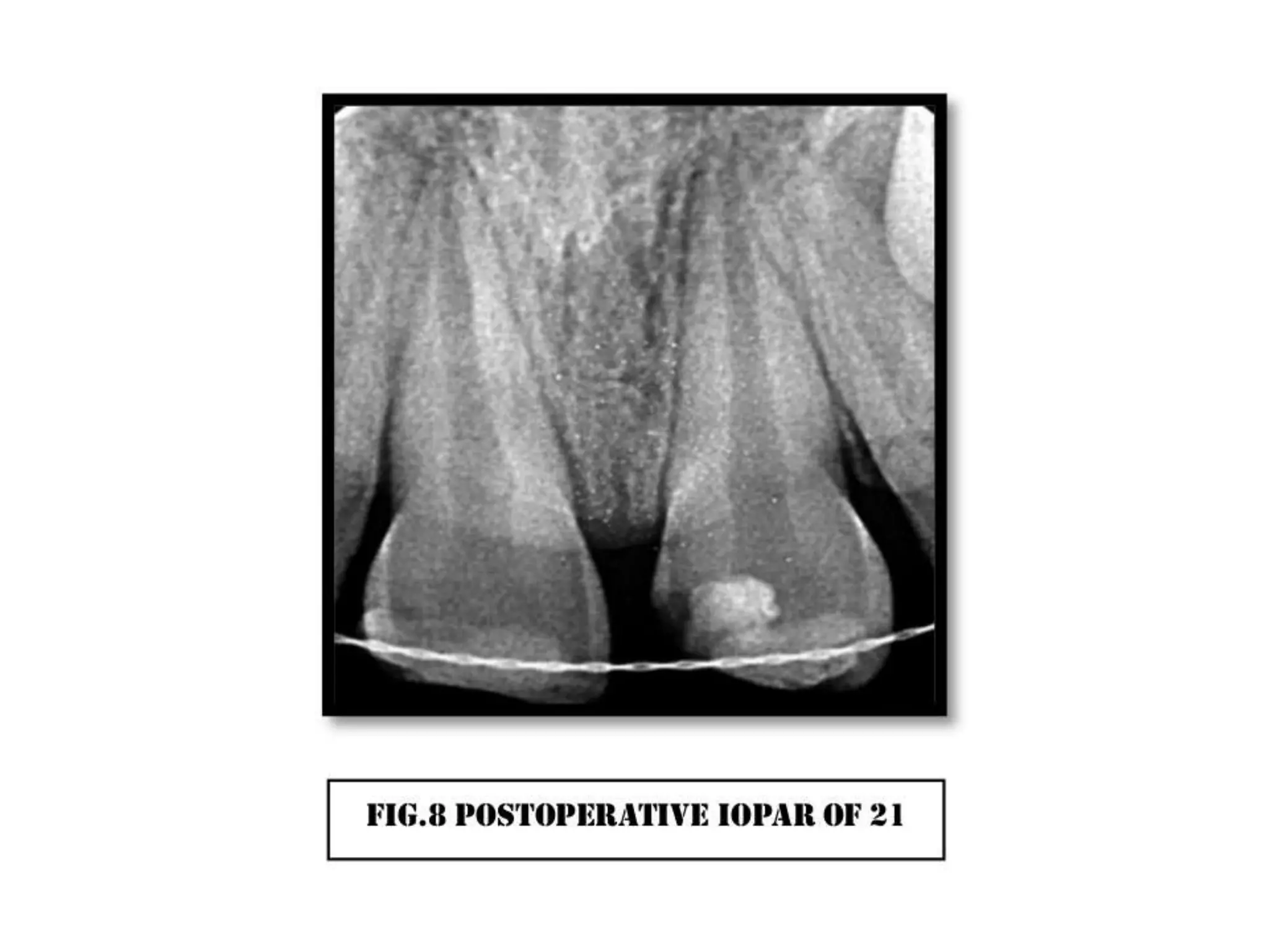 A case of cvek pulpotomy with mta