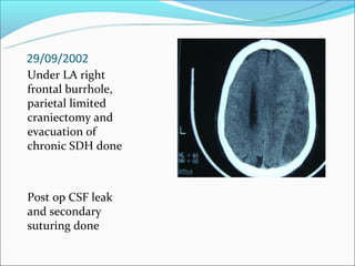 Subdural Empyema PPT subdural-empyema-ppt