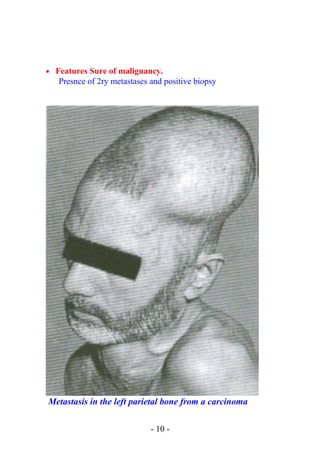 • Features Sure of malignancy.
Presnce of 2ry metastases and positive biopsy
Metastasis in the left parietal bone from a carcinoma
- 10 -
 
