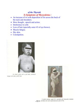 of the Thyroid.
5) Symptoms of Myxoedema :
• An increase of wt with deposition of fat across the back of
the neck and shoulders.
• Slow thought , speech and action.
• Intolerance to cold.
• Loss of hair (specially outer 43 of eye brows).
• Muscle fatigue.
• Dry skin.
• Constipation.
- 11 -
 