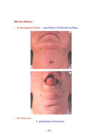 III) Past History :
- In thyroglossal fistula  → past history of infected swelling .
- In every case  →
 past history of toxicosis .
- 12 -
 