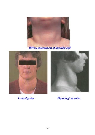 Diffuse enlargement of thyroid gland
Colloid goiter Physiological goiter
- 3 -
 