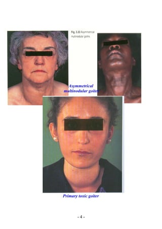 Asymmetrical
multinodular goiter
Primary toxic goiter
- 4 -
 