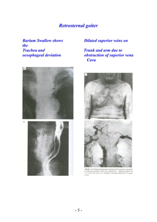 Retrosternal goiter
Barium Swallow shows Dilated superior veins on
the
Trachea and Trunk and arm due to
oesophageal deviation obstruction of superior vena
Cava
- 5 -
 