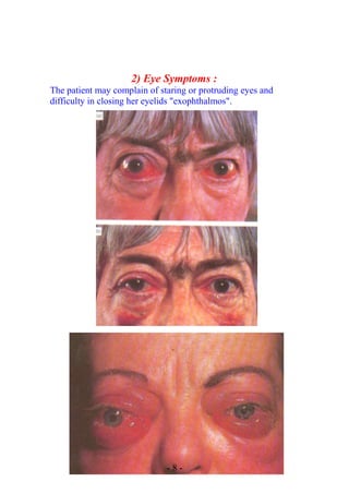 2) Eye Symptoms :
The patient may complain of staring or protruding eyes and
difficulty in closing her eyelids "exophthalmos".
- 8 -
 