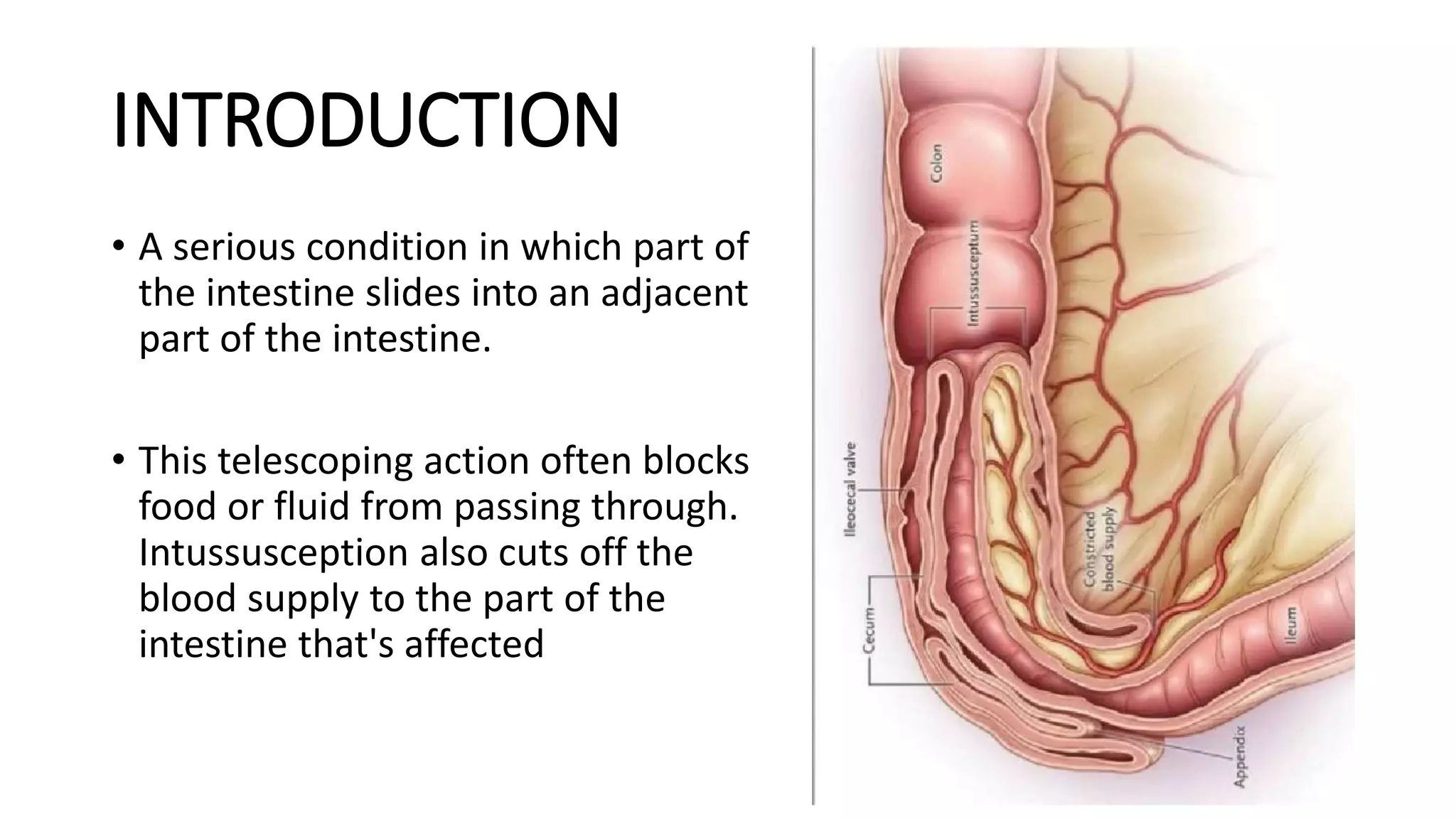 A case of intussusception with peutz jeghers syndrome.pptx