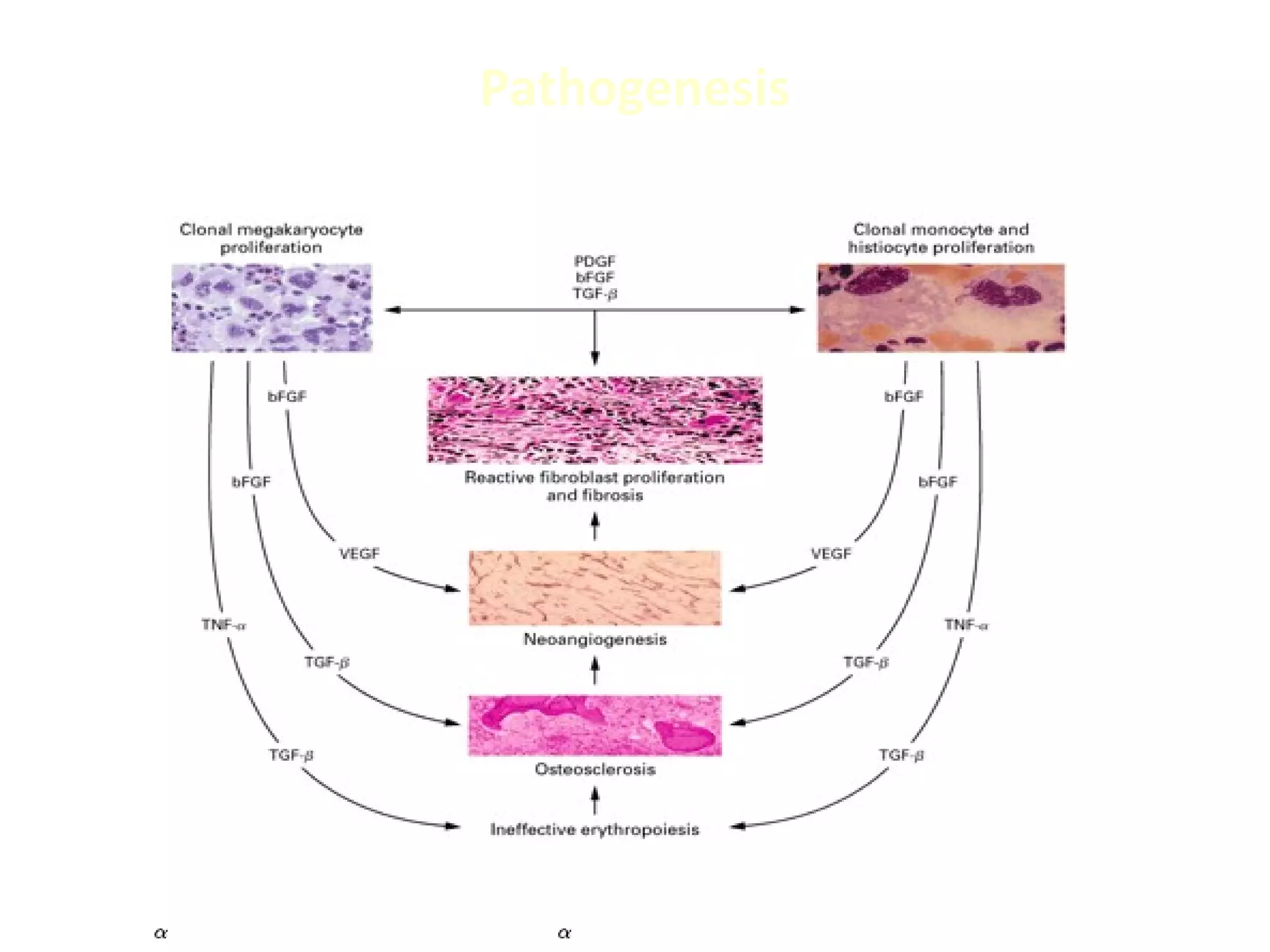 A Case of Primary Myelofibrosis | PPT