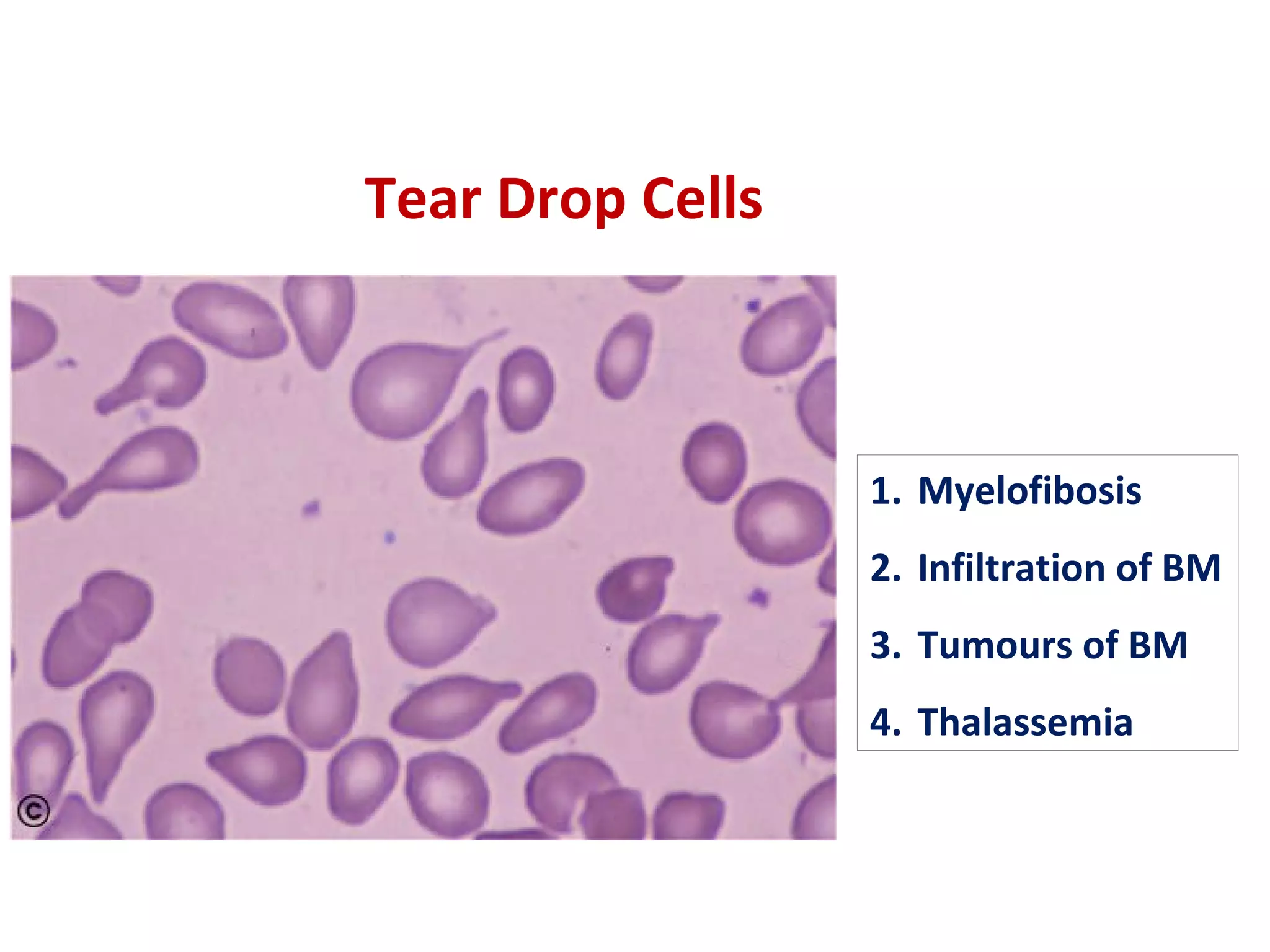 A Case of Primary Myelofibrosis | PPT