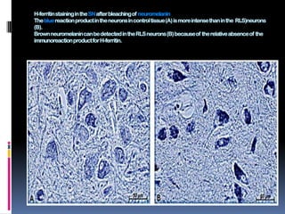 H-ferritin staining in the SN after bleaching of neuromelanin
The blue reaction product in the neurons in control tissue (A) is more intense than in the RLS)neurons
(B).
Brown neuromelanincan be detected in the RLS neurons (B) because of the relative absence of the
immunoreactionproduct for H-ferritin.
 