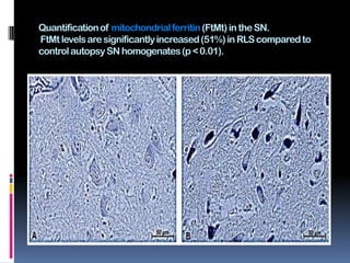 Quantification of mitochondrial ferritin (FtMt) in the SN.
FtMt levels are significantly increased (51%) in RLS compared to
control autopsy SN homogenates (p < 0.01).
 