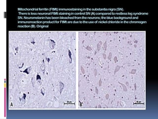 Mitochondrial ferritin (FtMt) immunostaining in the substantia nigra (SN).
 There is less neuronal FtMt staining in control SN (A) compared to restless leg syndrome
SN. Neuromelanin has been bleached from the neurons; the blue background and
immunoreactionproduct for FtMt are due to the use of nickel chloride in the chromogen
reaction (B). Original
 