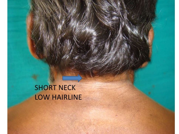 A Case Of Short Neck