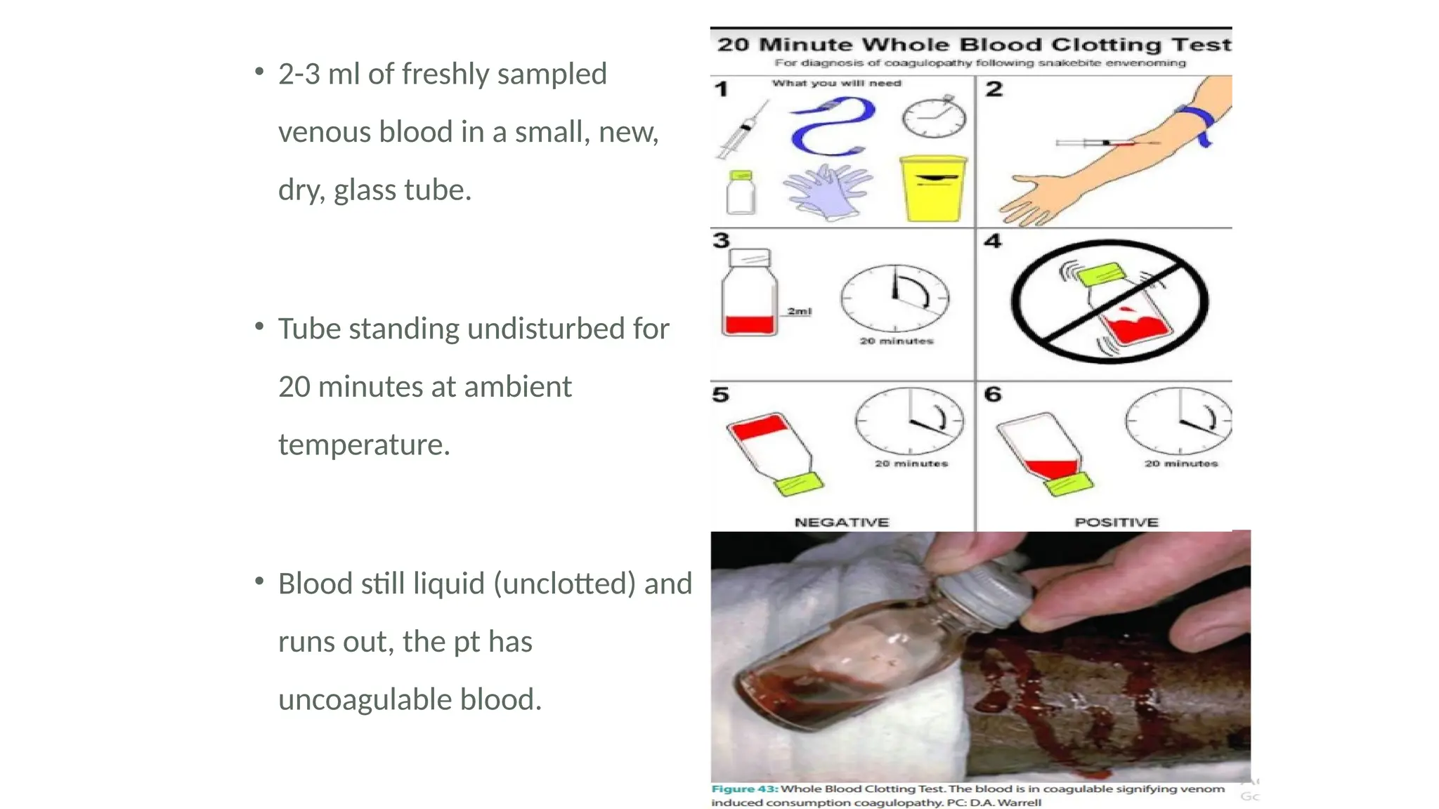 • 2-3 ml of freshly sampled
venous blood in a small, new,
dry, glass tube.
• Tube standing undisturbed for
20 minutes at ambient
temperature.
• Blood still liquid (unclotted) and
runs out, the pt has
uncoagulable blood.
 