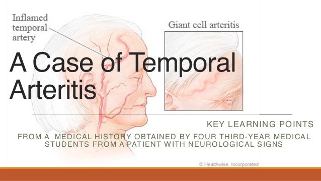 What is temporal arthritis?