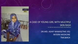 A CASE OF YOUNG GIRL WITH MULTIPLE
SKIN RASH
PICTURES ARE TAKEN WITH DUE RESPECT AND PERMISSION
DR.MD. ASHIF NAWAS(TMC-05)
INTERN MEDICINE
TMC&RCH
 