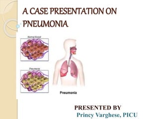 A CASE PRESENTATION ON
PNEUMONIA
PRESENTED BY
PM
PRESENTED BY
Princy Varghese, PICU
 