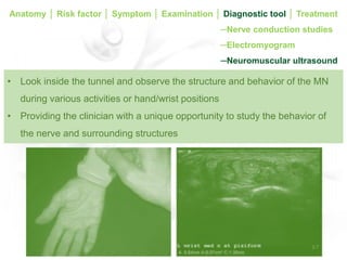 A case report of carpal tunnel syndrome | PDF