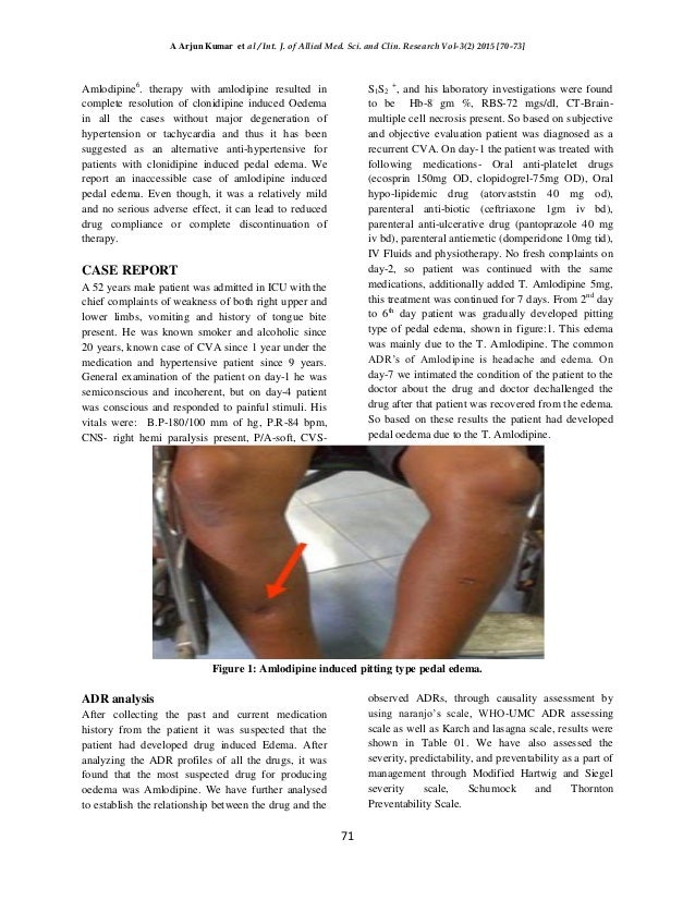 A case report on amlodepine induced pedal edema pitting type