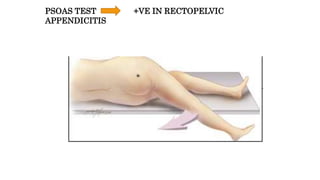 PSOAS TEST +VE IN RECTOPELVIC
APPENDICITIS
 