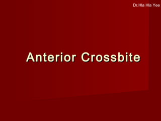 Anterior CrossbiteAnterior Crossbite
Dr.Hla Hla Yee
 