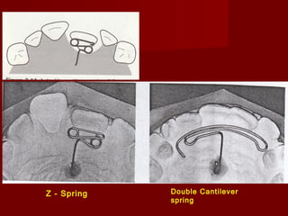 Z - Spring Double Cantilever
spring
 