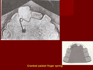 Cranked palatal finger spring
 