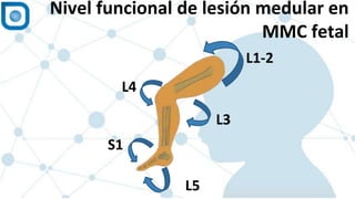 1
Nivel funcional de lesión medular en
MMC fetal
S1
L5
L4
L3
L1-2
 