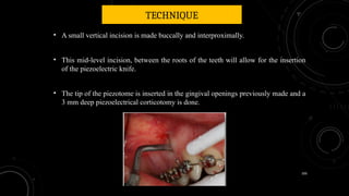 100
TECHNIQUE
• A small vertical incision is made buccally and interproximally.
• This mid-level incision, between the roots of the teeth will allow for the insertion
of the piezoelectric knife.
• The tip of the piezotome is inserted in the gingival openings previously made and a
3 mm deep piezoelectrical corticotomy is done.
 