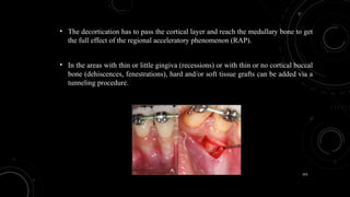 101
• The decortication has to pass the cortical layer and reach the medullary bone to get
the full effect of the regional acceleratory phenomenon (RAP).
• In the areas with thin or little gingiva (recessions) or with thin or no cortical buccal
bone (dehiscences, fenestrations), hard and/or soft tissue grafts can be added via a
tunneling procedure.
 