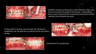 103
Modified corticotomy/Peizocision avoids reflecting a flap, using
thin micro-incisions through the facial tissue. A piezoelectric
knife is used to penetrate the cortical bone and extend into the
medullary bone between the teeth.
If a bone graft is desired, a tunnel under the soft tissue is
established, and the graft slurry is placed into the area with a
syringe.
Finished Case Ten months later.
 