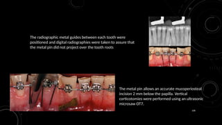 108
The radiographic metal guides between each tooth were
positioned and digital radiographies were taken to assure that
the metal pin did not project over the tooth roots
The metal pin allows an accurate mucoperiosteal
incision 2 mm below the papilla. Vertical
corticotomies were performed using an ultrasonic
microsaw OT7.
 