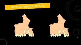MICRO-OSTEOPERFORATIONS
109
 