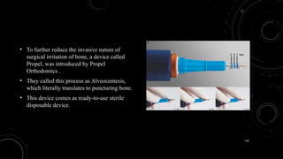 110
• To further reduce the invasive nature of
surgical irritation of bone, a device called
Propel, was introduced by Propel
Orthodontics .
• They called this process as Alveocentesis,
which literally translates to puncturing bone.
• This device comes as ready-to-use sterile
disposable device.
 