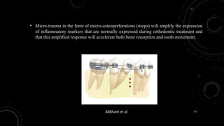112
• Micro-trauma in the form of micro-osteoperforations (mops) will amplify the expression
of inflammatory markers that are normally expressed during orthodontic treatment and
that this amplified response will accelerate both bone resorption and tooth movement.
Alikhani et al
 