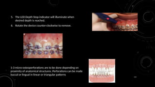 114
5. The LED Depth Stop indicator will illuminate when
desired depth is reached.
6. Rotate the device counter-clockwise to remove.
1-3 micro-osteoperforations are to be done depending on
proximity of anatomical structures. Perforations can be made
buccal or lingual in linear or triangular patterns
 