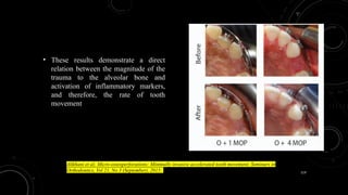 119
• These results demonstrate a direct
relation between the magnitude of the
trauma to the alveolar bone and
activation of inflammatory markers,
and therefore, the rate of tooth
movement
Alikhani et al; Micro-osteoperforations: Minimally invasive accelerated tooth movement; Seminars in
Orthodontics, Vol 21, No 3 (September), 2015:
 
