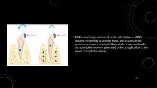 122
• MOPs can change location of center of resistance. MOPs
reduces the density of alveolar bone, and as a result the
center of resistance of a tooth (blue circle) moves occlusally,
decreasing the moment generated by force application to the
crown (curved blue arrow) .
 