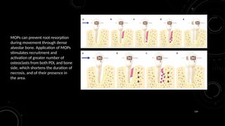 124
MOPs can prevent root resorption
during movement through dense
alveolar bone. Application of MOPs
stimulates recruitment and
activation of greater number of
osteoclasts from both PDL and bone
side, which shortens the duration of
necrosis, and of their presence in
the area.
 