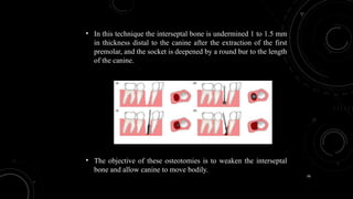 56
• In this technique the interseptal bone is undermined 1 to 1.5 mm
in thickness distal to the canine after the extraction of the first
premolar, and the socket is deepened by a round bur to the length
of the canine.
• The objective of these osteotomies is to weaken the interseptal
bone and allow canine to move bodily.
 