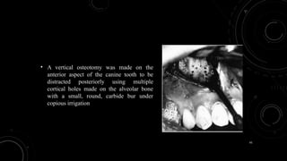 61
• A vertical osteotomy was made on the
anterior aspect of the canine tooth to be
distracted posteriorly using multiple
cortical holes made on the alveolar bone
with a small, round, carbide bur under
copious irrigation
 