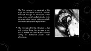 63
• The first premolar was extracted at this
stage, and the buccal bone was carefully
removed through the extraction socket
using large, round burs between the bone
cut at the distal canine region anteriorly
and the second premolar posteriorly.
• The bone apical to the extraction socket
and possible bony interferences at the
buccal aspect that may be encountered
during the distraction process were
eliminated.
 
