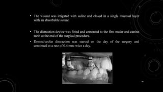 64
• The wound was irrigated with saline and closed in a single mucosal layer
with an absorbable suture.
• The distraction device was fitted and cemented to the first molar and canine
teeth at the end of the surgical procedure.
• Dentoalveolar distraction was started on the day of the surgery and
continued at a rate of 0.4 mm twice a day.
 