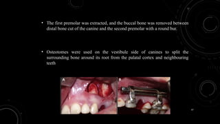 67
• The first premolar was extracted, and the buccal bone was removed between
distal bone cut of the canine and the second premolar with a round bur.
• Osteotomes were used on the vestibule side of canines to split the
surrounding bone around its root from the palatal cortex and neighbouring
teeth
 
